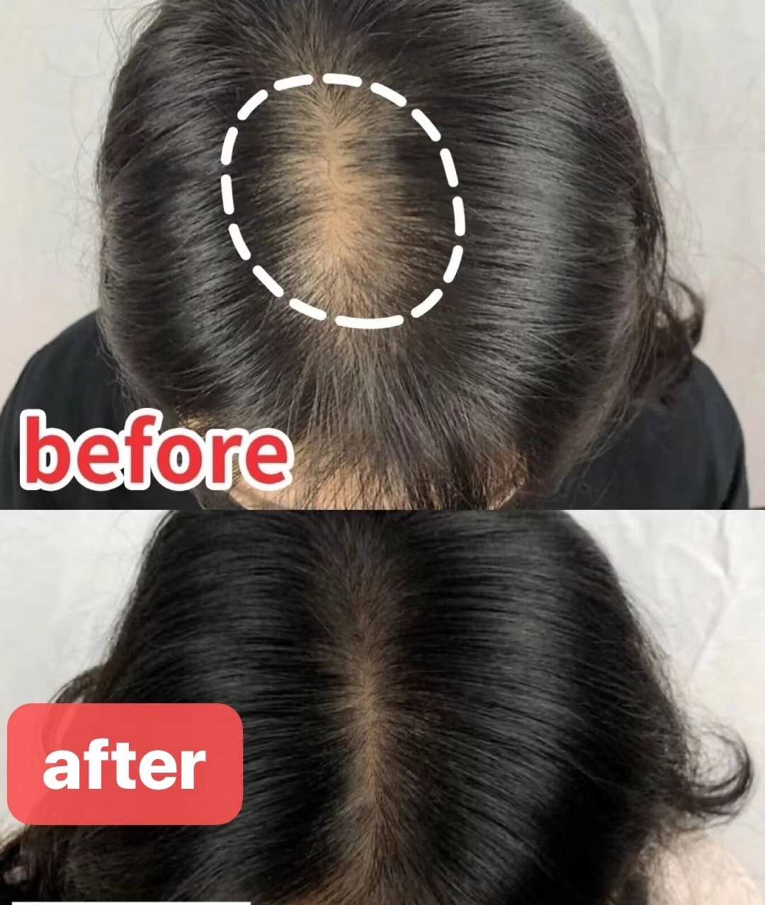 Why are there so many hair loss people?